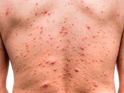Suma Q. Roo 9 casos de viruela del mono