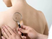 Detectan dermatólogos 31 casos de cáncer de piel durante jornada en Cancún