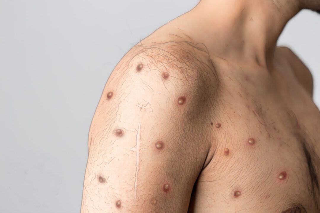 MPOX